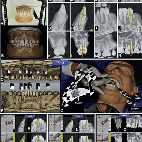 Dynamic Navigation In Endodontics Request Pdf