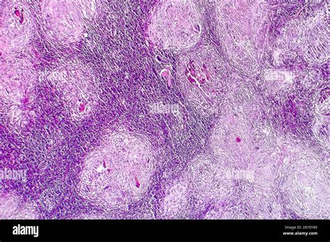 Caseous Necrosis Histology