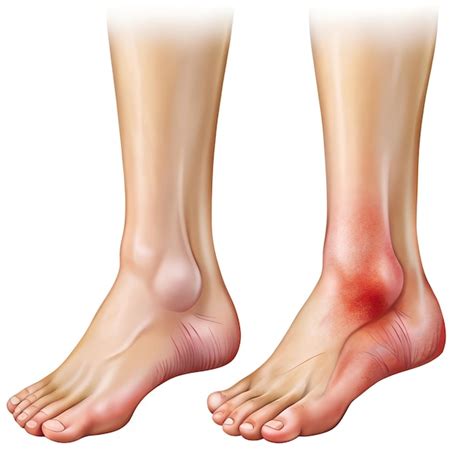 Swollen Ankles Illustrated Guide To Causes Treatment And Prevention