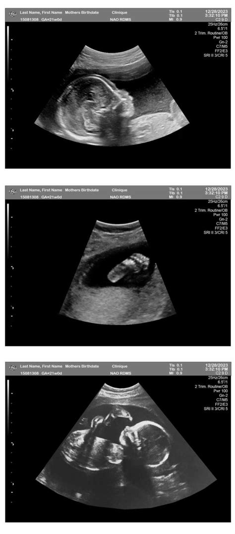 21 Week Pregnancy Ultrasound - Ultrasounds