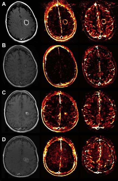 Mr Perfusion And Mr Spectroscopy Of Brain Neoplasms Radiologic Clinics