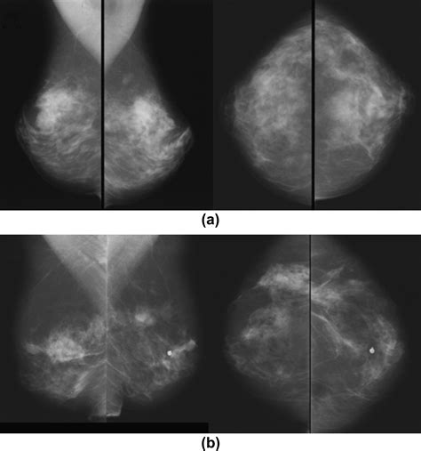 Screening For Breast Cancer Post Reduction Mammoplasty Clinical Radiology