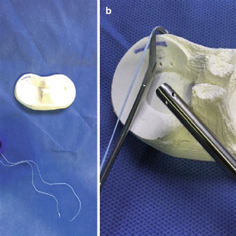 Pdf Meniscal Repair Indications Techniques And Outcome