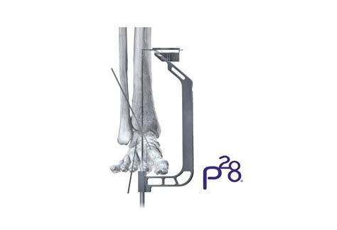 Paragon 28 Announces Launch Of Phantom Hindfoot TTC TC System To