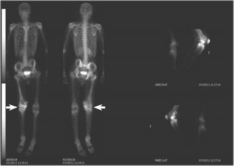 Anterior And Posterior Projections From Tc M Whole Body Bone Scan Are