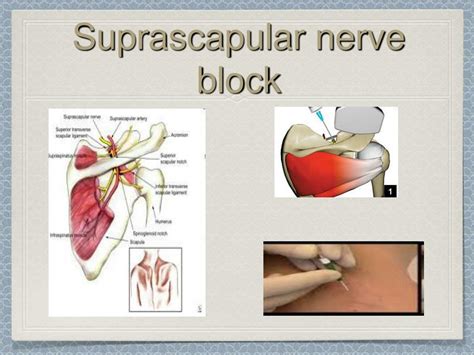 Suprascapular Nerve Anatomy