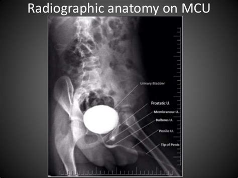 Anterograde Retrograde Urethrography Rgu Mcu