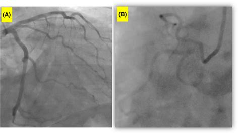 Cardiac angiography shows normal (A) left and (B) right coronary ...