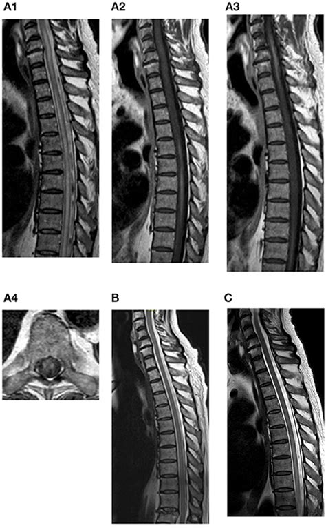 Frontiers Case Report Longitudinal Extensive Transverse Myelitis With Novel Autoantibodies