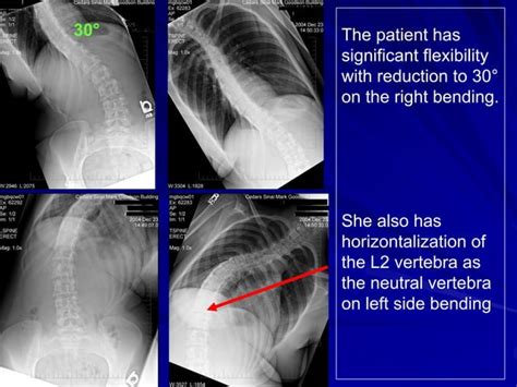 Case Presentation1 20 Year Old Female With Adolescent Idiopathic