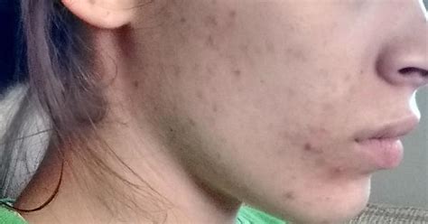 Accutane Before And After Album On Imgur