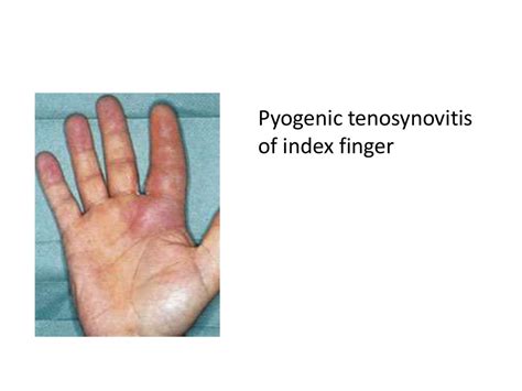 Hand Infections