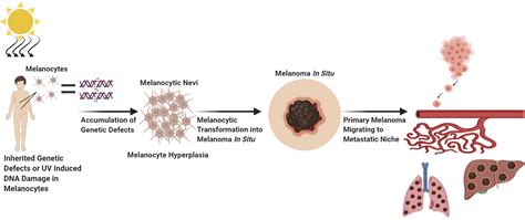 Malignant Melanoma Stages