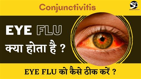 Eye Flu होने पर क्या करें Conjunctivitis Cause And Treatment Youtube