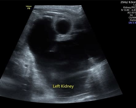 Hydronephrosis Grading Ultrasound