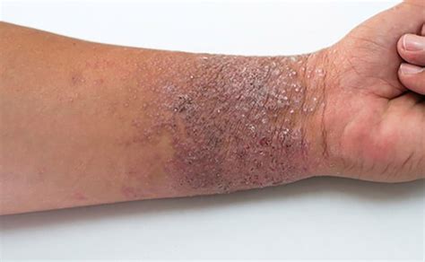 Fotos de dermatite atópica bebês crianças e adultos