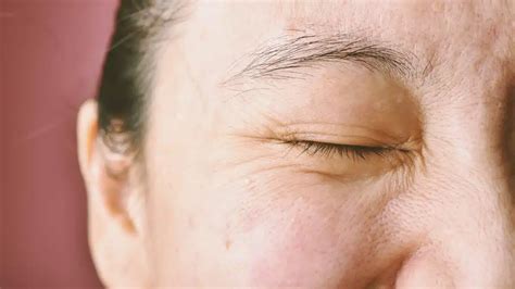 Dealing With Dry Skin Around Eyes Causes And Effective Solutions