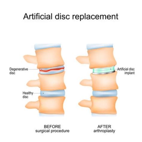 Which Is Better Spinal Fusion Or Cervical Artificial Disc Replacement