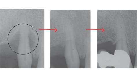 periodontal bone grafting  regenerative approach  gum disease