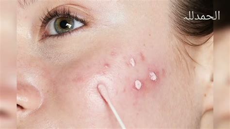 How We Remove Pimple Acne Scares Remove Acne Remove Patches Of