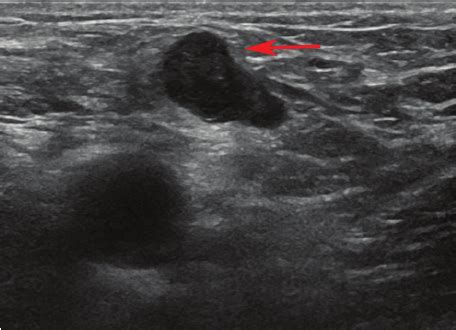 Inguinal Lymph Nodes Ultrasound