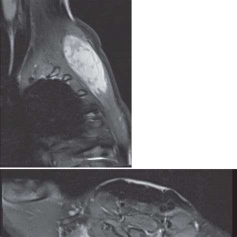 Right Parasagittal And Axial Sections Of T Weighted Mri Demonstrating