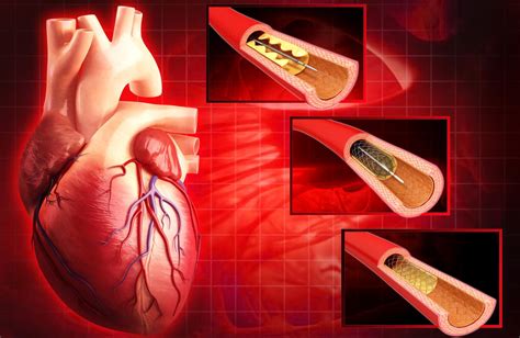 Coronary Angioplasty - Procedure Details