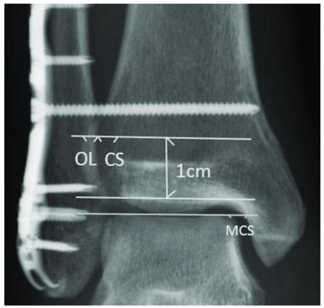 Radiographic Evaluation In The Study The Tibiofibular Clear Space Cs