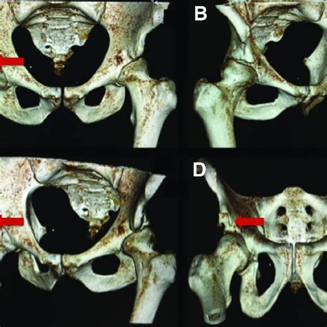 PDF Arthroscopic Decompression Of A Type III Subspine Impingement