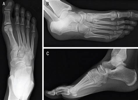 Radiographically Occult Medial Cuneiform Impaction Fracture Journal