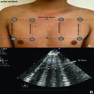 Detection of B-lines by lung ultrasound. | Download Scientific Diagram