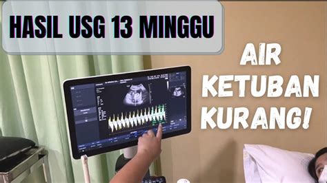 Hasil Usg 13 Minggu Usg 3 Bulan Usg Trimester 2 Perkembangan