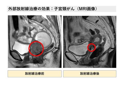 放射線治療は“がん治療の三本柱”の1つ｜放射線アカデミア