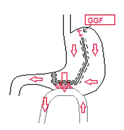 Schematic Representation Showing The Bridge At The Most Cranial 2 Cm Of