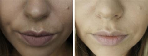 Nasolabial Fold Filler | Essence of Beauty: Skin Health & Aesthetics