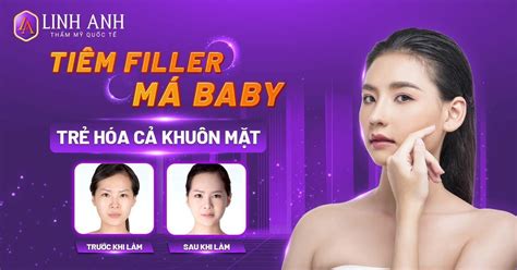 Tiêm Filler Má Baby Giữ Bao Lâu Bao Nhiêu Cc Giá 2023