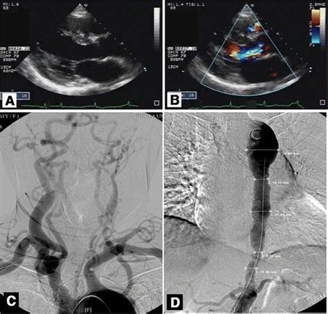 Echocardiographic And Angiographic Findings Of Case 2 Parasternal Long