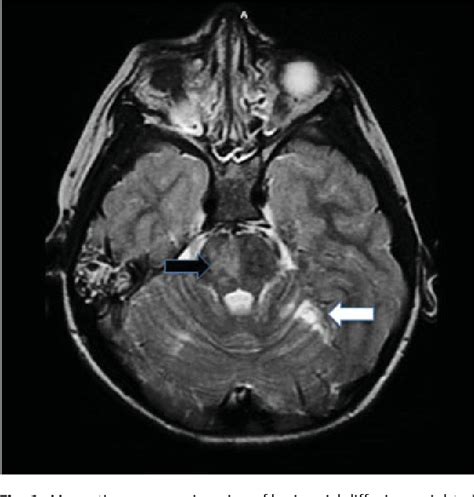 Figure From Traumatic Vertebral Artery Dissection And Basilar Artery