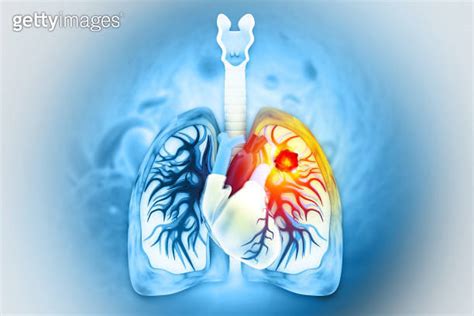 D Rendered Medically Accurate Illustration Of Lung Cancer Showing