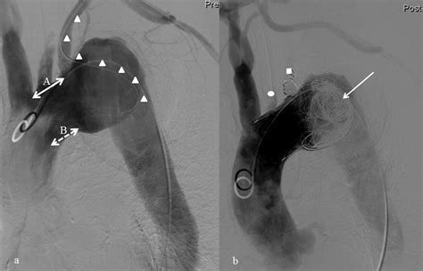 Preemptive Aneurysm Sac Embolization For Thoracic Endovascular Aortic