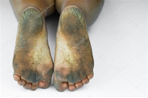 Bad Feet Pics – Telegraph