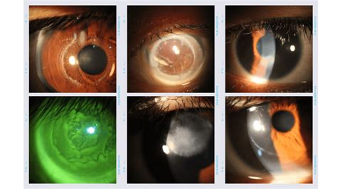 Scleral Contact Lens And Kerasoft Ic Fitting For Keratoconus Gold