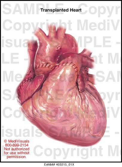 Transplanted Heart Medical Illustration Medivisuals