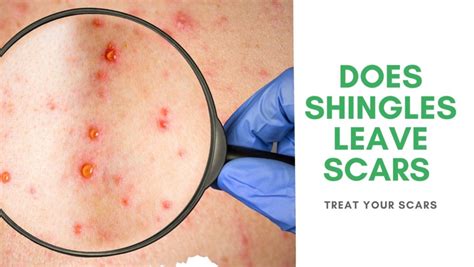 Does Shingles Leave Scars - Treat Your Scars