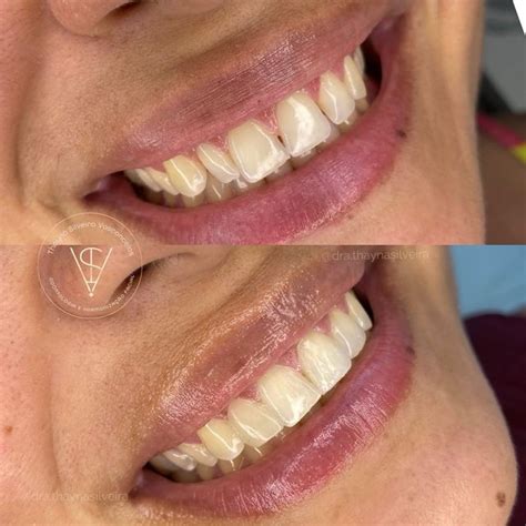 Clínica Dentista Fortaleza on Instagram Reanatomização dos