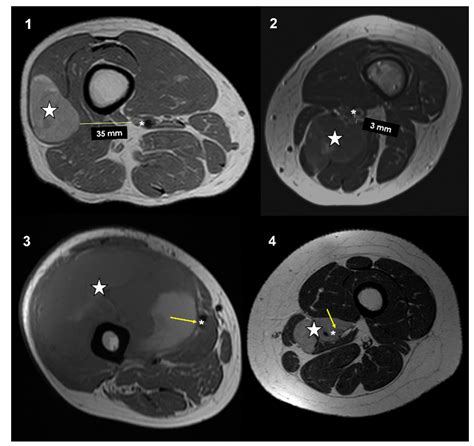 Cancers Free Full Text Vascular Proximity Increases The Risk Of