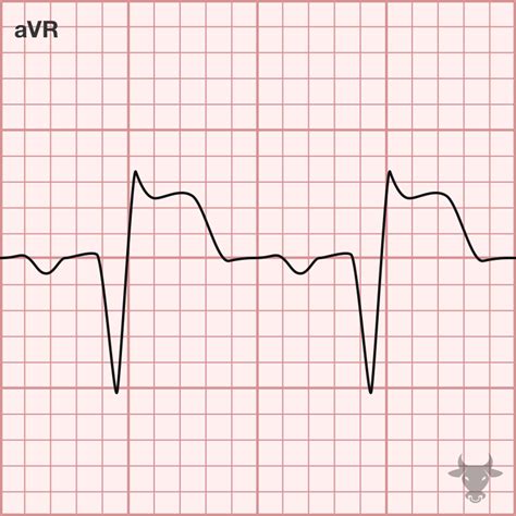 Subendocardial Infarction Ecg