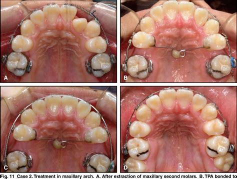 Figure 11 From Treatment Of Class III Relapse Due To Late Mandibular