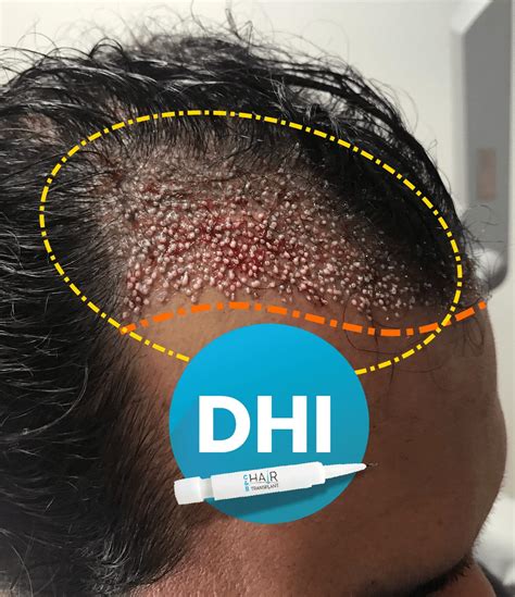 Haartransplantation Mit Der Dhi Technik C B Hairtransplant