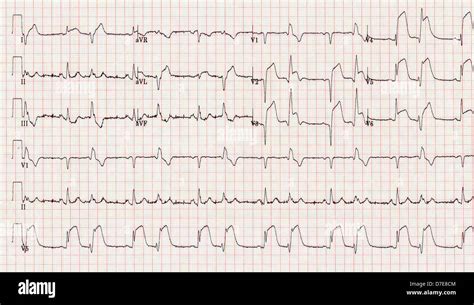 Electrocardiograma Infarto Miocardio Fotograf As E Im Genes De Alta